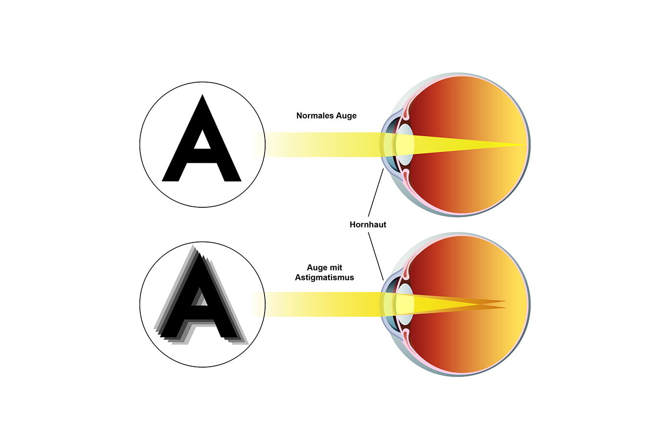 Hornhautverkrümmung (Astigmatismus) Schönert Optik