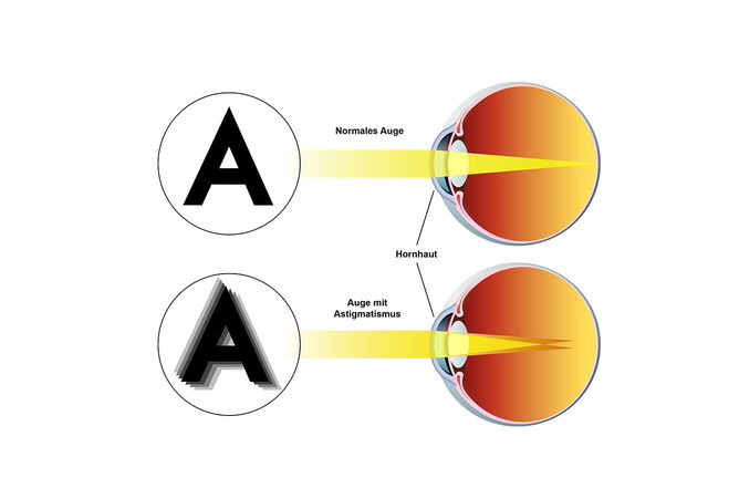 Hornhautverkrümmung 