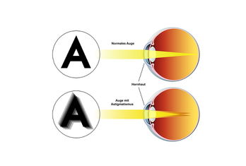 Hornhautverkrümmung 